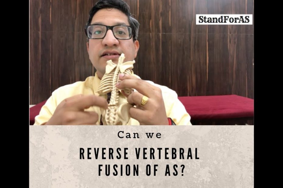 Can We Reverse Vertebral Fusion Related To Ankylosing Spondylitis? - Youtube
