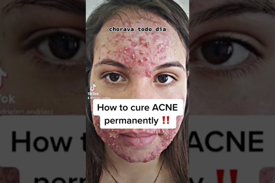 can-acne-be-cured-permanently-unveiling-lasting-solutions